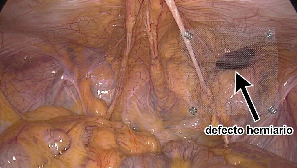 image-gallery-hernias-006