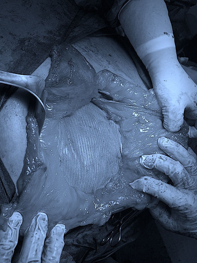 image-gallery-hernias-008