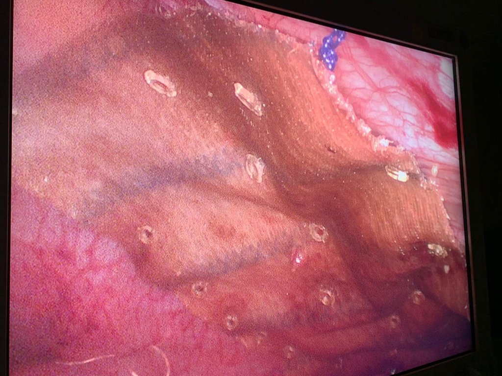 image-gallery-hernias-009