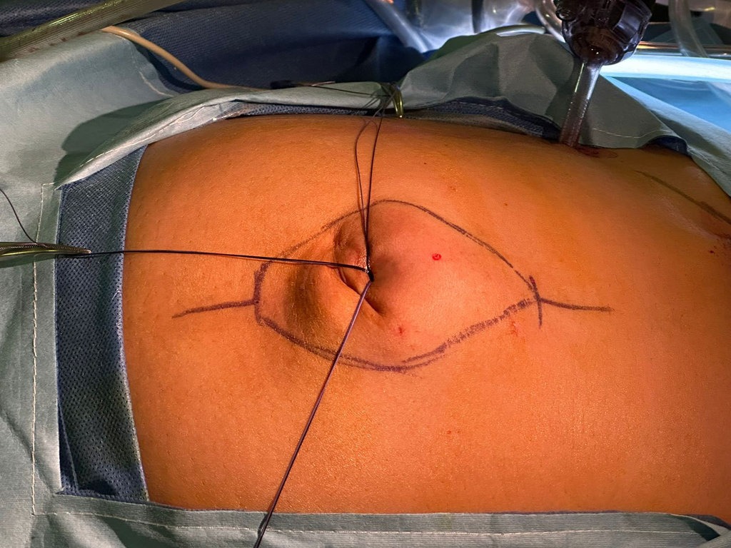 image-gallery-hernias-012